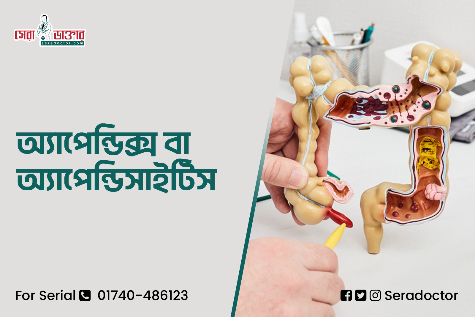 অ্যাপেন্ডিক্স বা অ্যাপেন্ডিসাইটিস কি, লক্ষণ ও চিকিৎসা